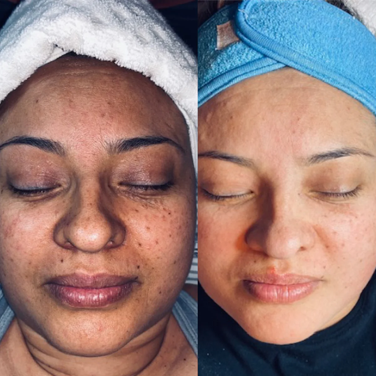 Glycolic 50% Gel Peel - Image 7